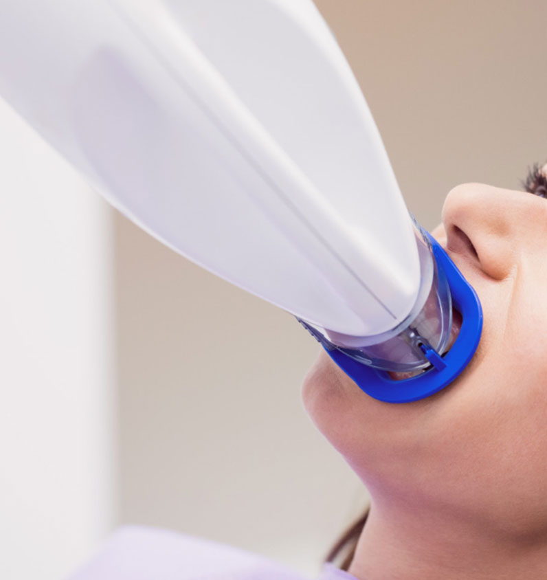 Diş Beyazlatma (Bleaching) Nedir ve Nasıl Yapılır?