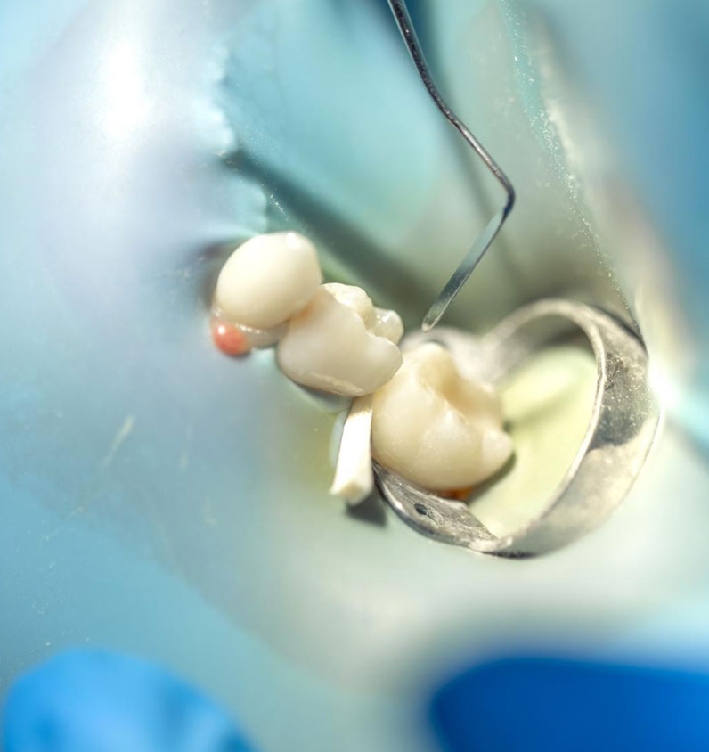 Kanal Tedavisi (Endodonti) Nedir ve Nasıl Yapılır?